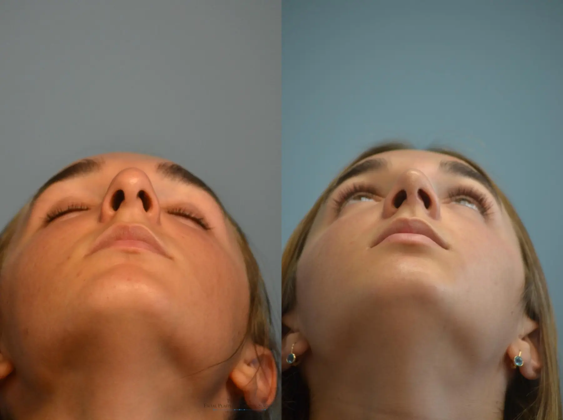 Rhinoplasty: Patient 8 - Before and After 5
