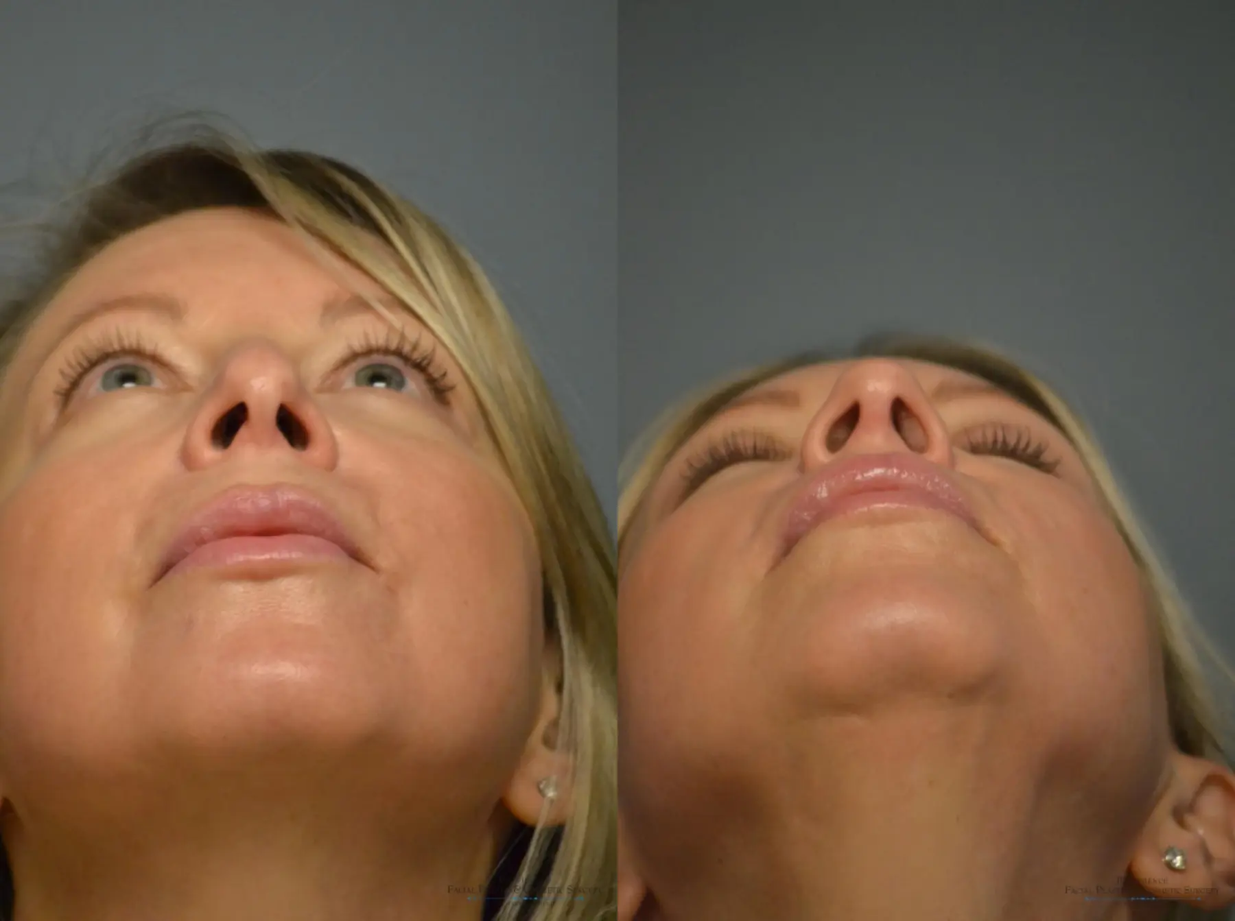 Rhinoplasty: Patient 4 - Before and After 5