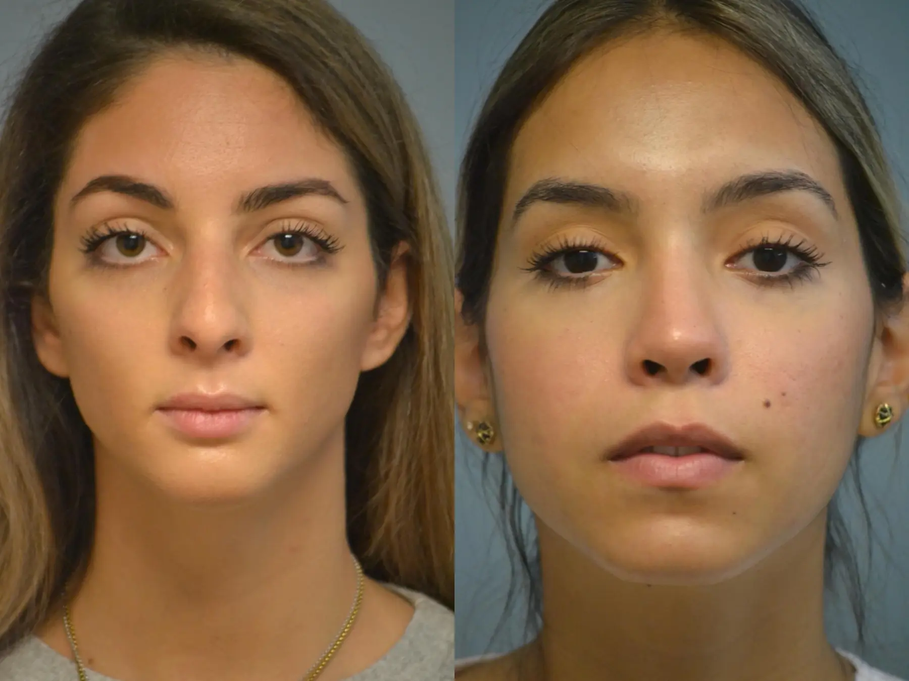 Rhinoplasty: Patient 24 - Before and After 1