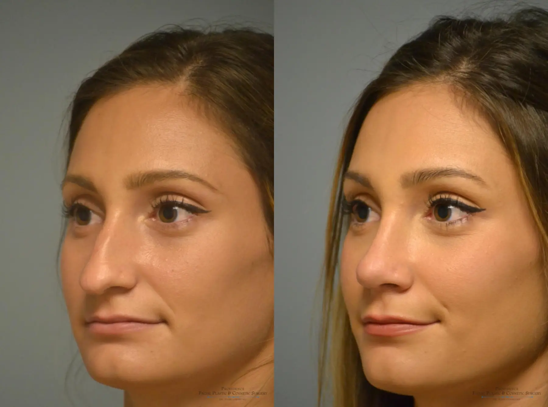 Rhinoplasty: Patient 1 - Before and After 2