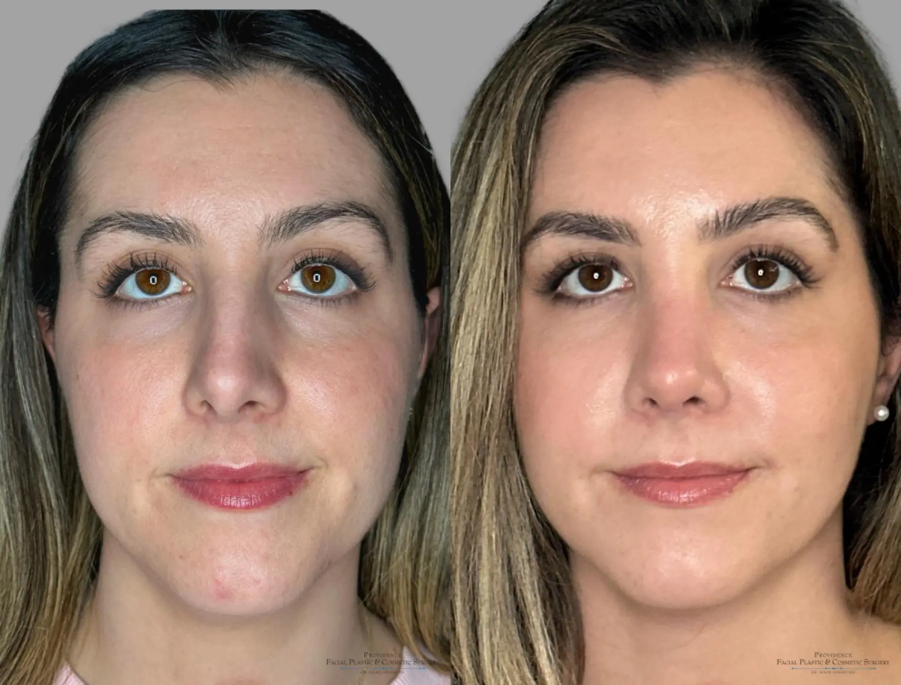 Rhinoplasty: Patient 40 - Before and After 1