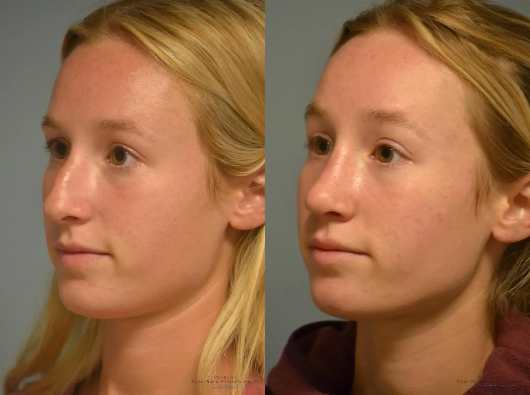 Rhinoplasty: Patient 22 - Before and After 2