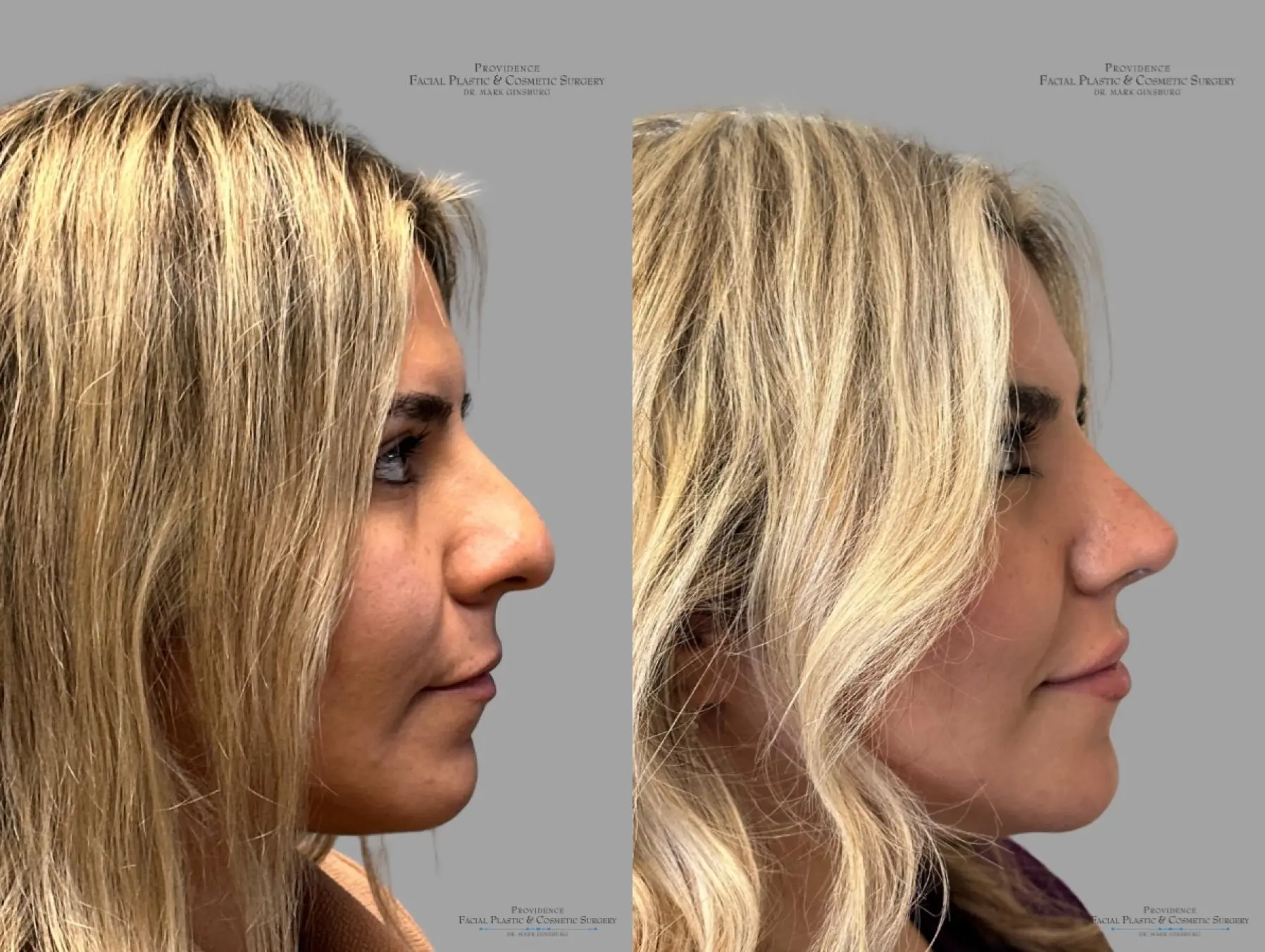 Rhinoplasty: Patient 35 - Before and After 4