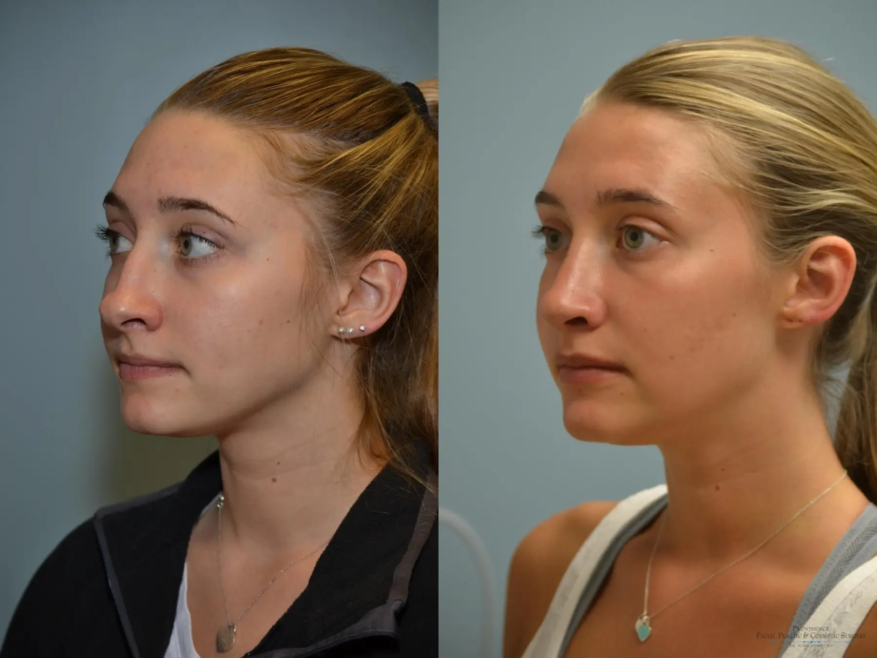 Rhinoplasty: Patient 19 - Before and After 2