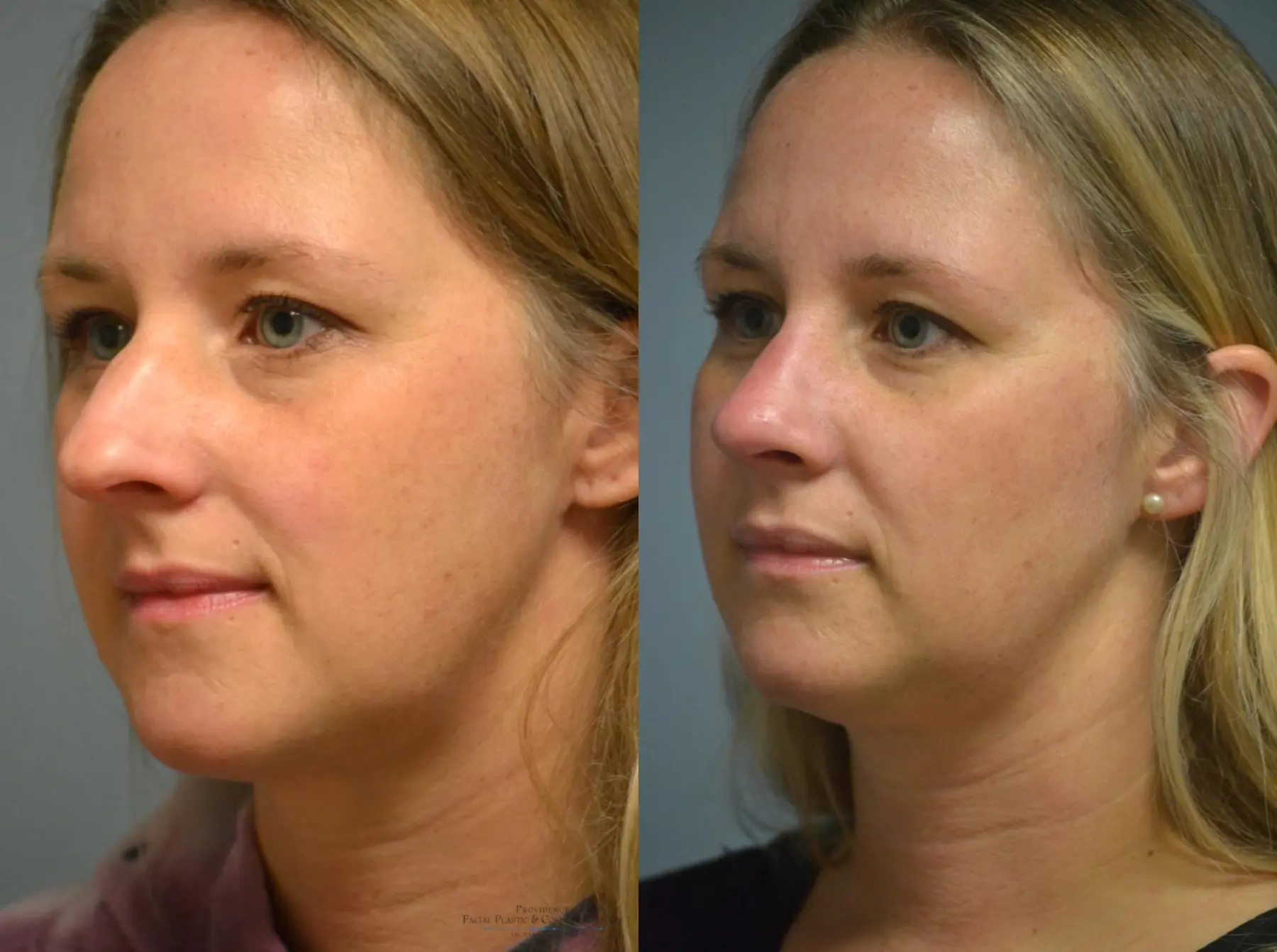 Rhinoplasty: Patient 6 - Before and After 2