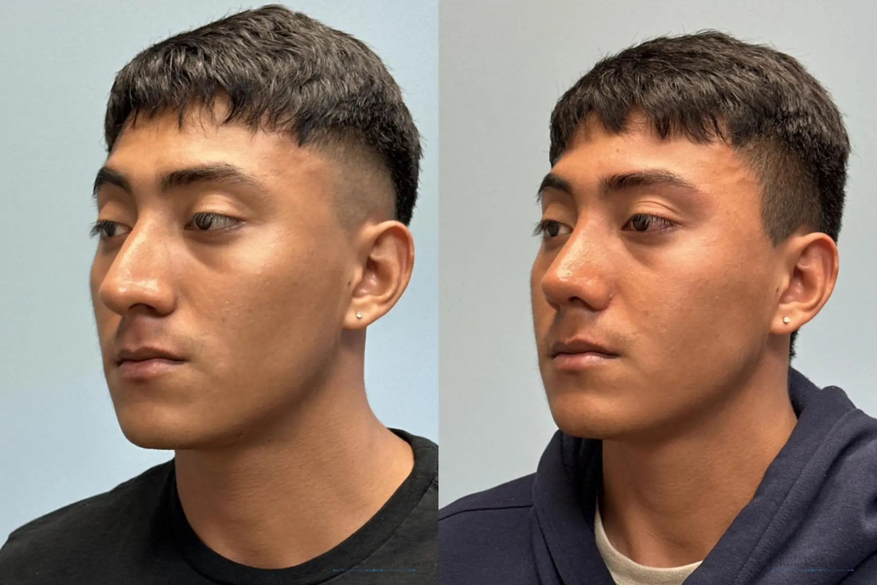 Rhinoplasty: Patient 38 - Before and After 2