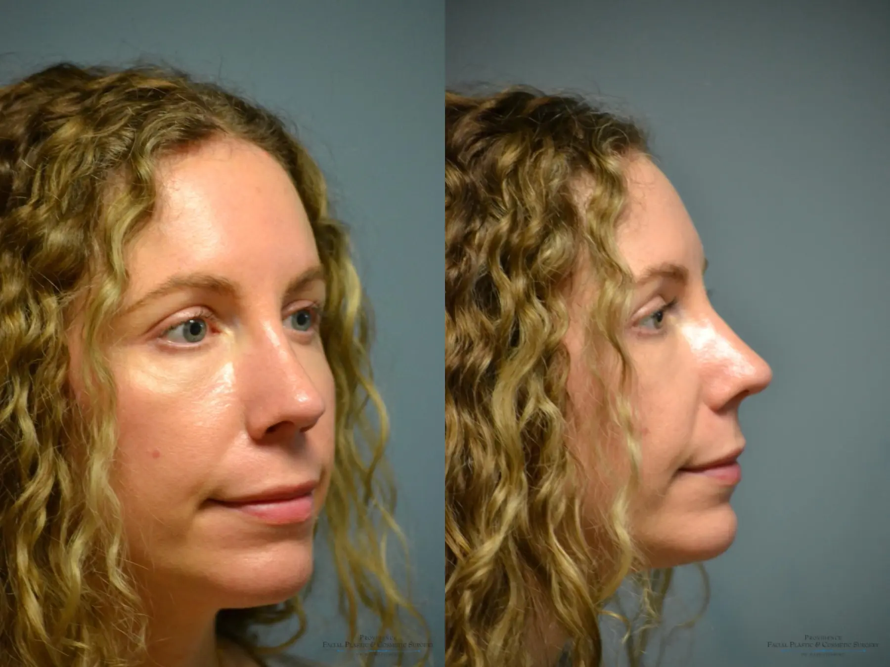 Rhinoplasty: Patient 35 - Before and After 2