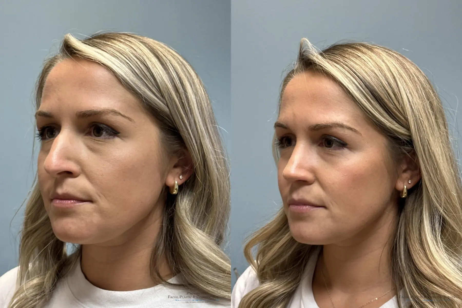 Rhinoplasty: Patient 28 - Before and After 2