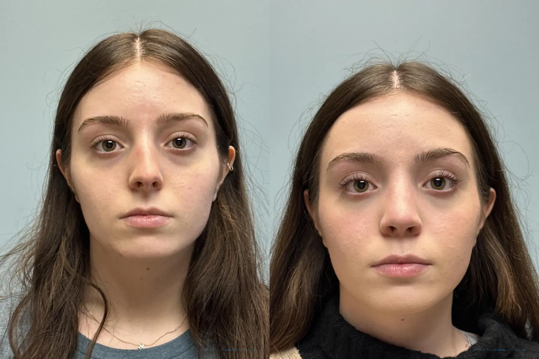Rhinoplasty: Patient 36 - Before and After 1