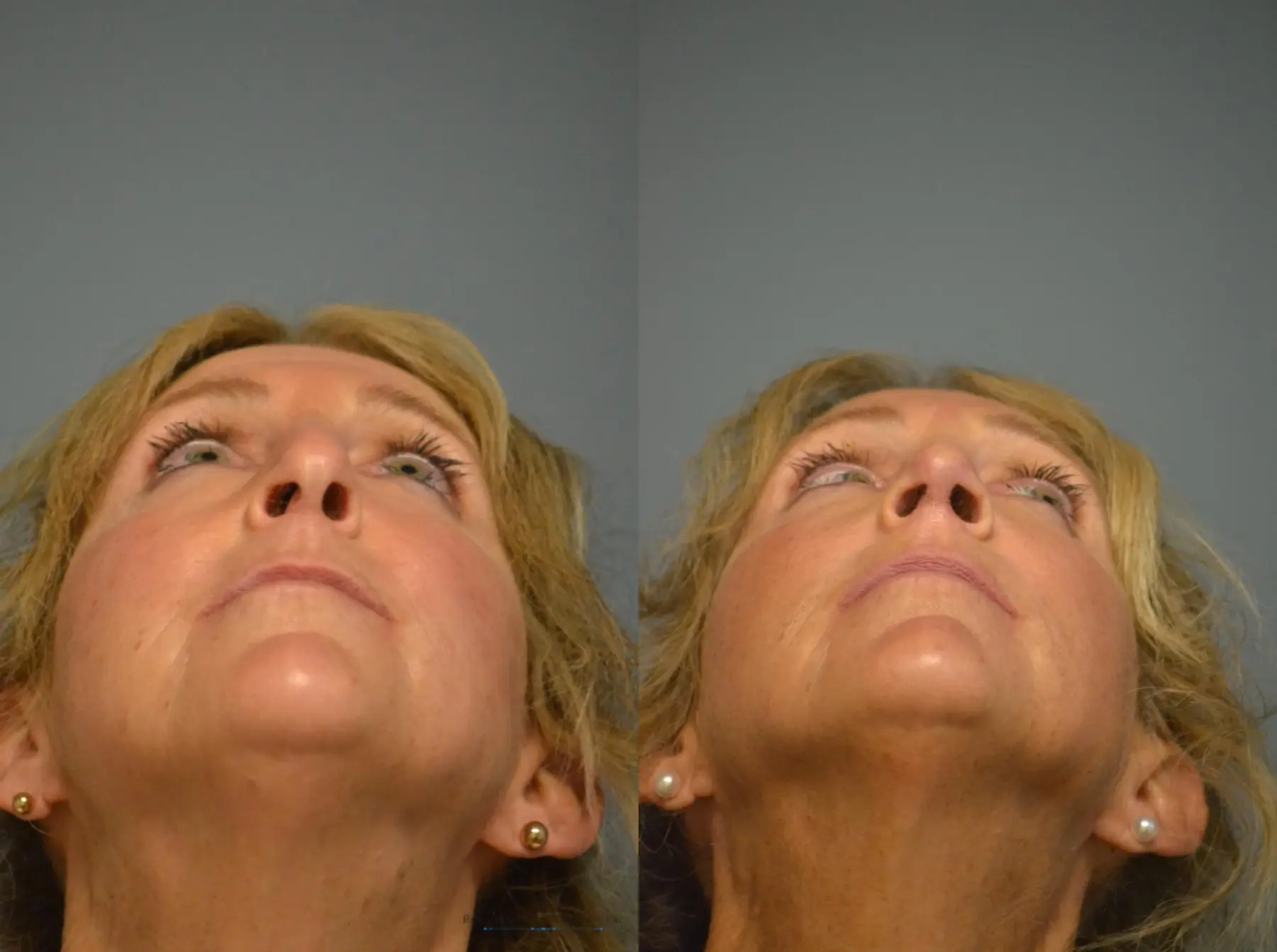 Rhinoplasty: Patient 14 - Before and After 5
