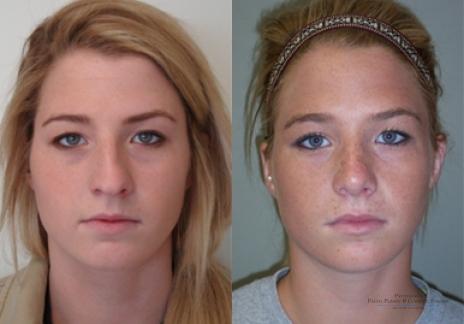 Rhinoplasty: Patient 29 - Before and After 1