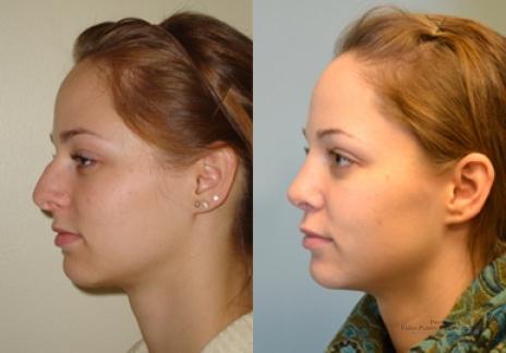 Rhinoplasty: Patient 34 - Before and After 3