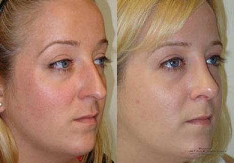 Rhinoplasty: Patient 21 - Before and After 1