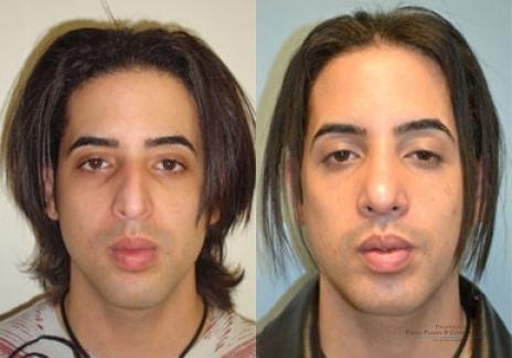 Rhinoplasty: Patient 19 - Before and After 2
