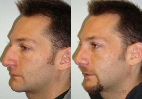 Rhinoplasty: Patient 28 - Before and After 2