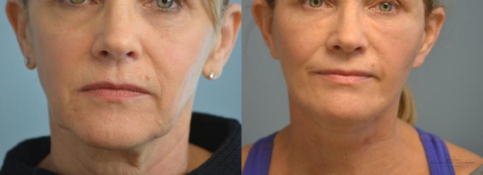 Facelift: Patient 10 - Before and After  