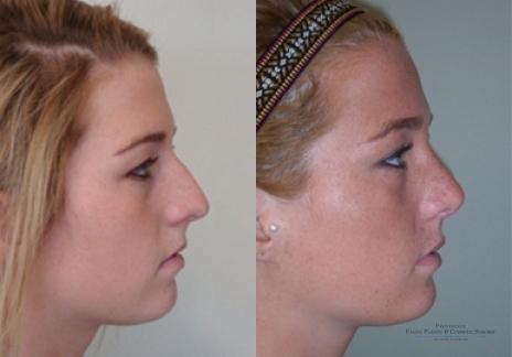 Rhinoplasty: Patient 29 - Before and After 3