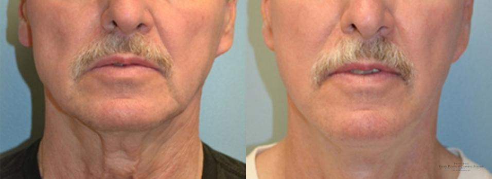 Facelift: Patient 5 - Before and After 2