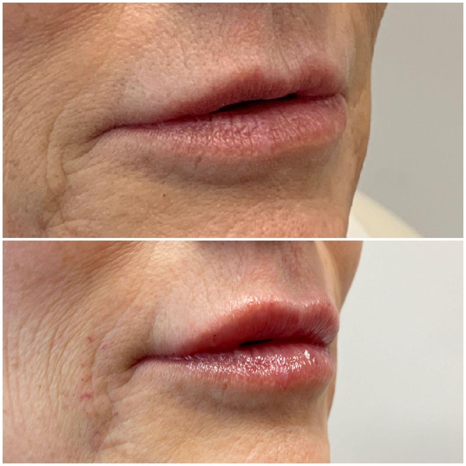 Fillers: Patient 5 - Before and After 1