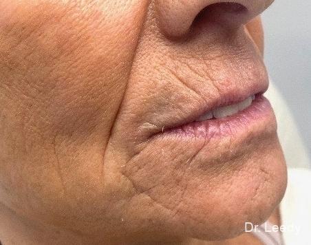 Fillers: Patient 1 - After  