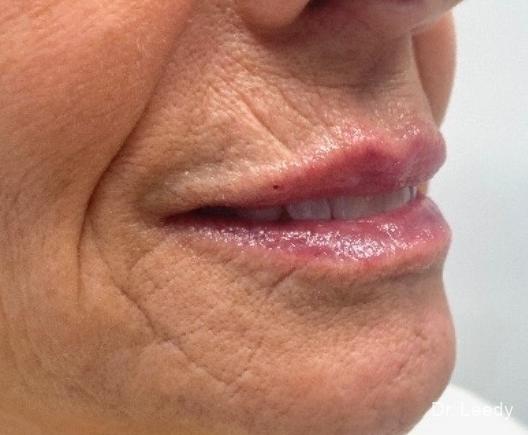 Fillers: Patient 1 - After  