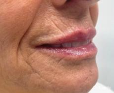 Fillers: Patient 1 - After 
