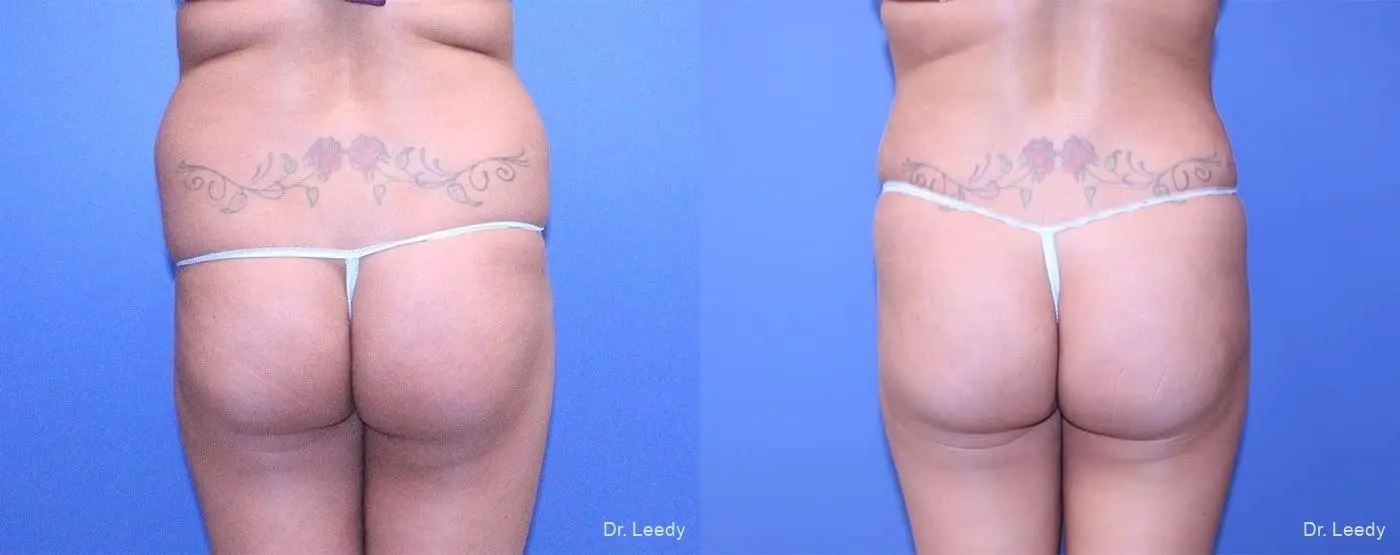 Abdominoplasty: Patient 6 - Before and After 7