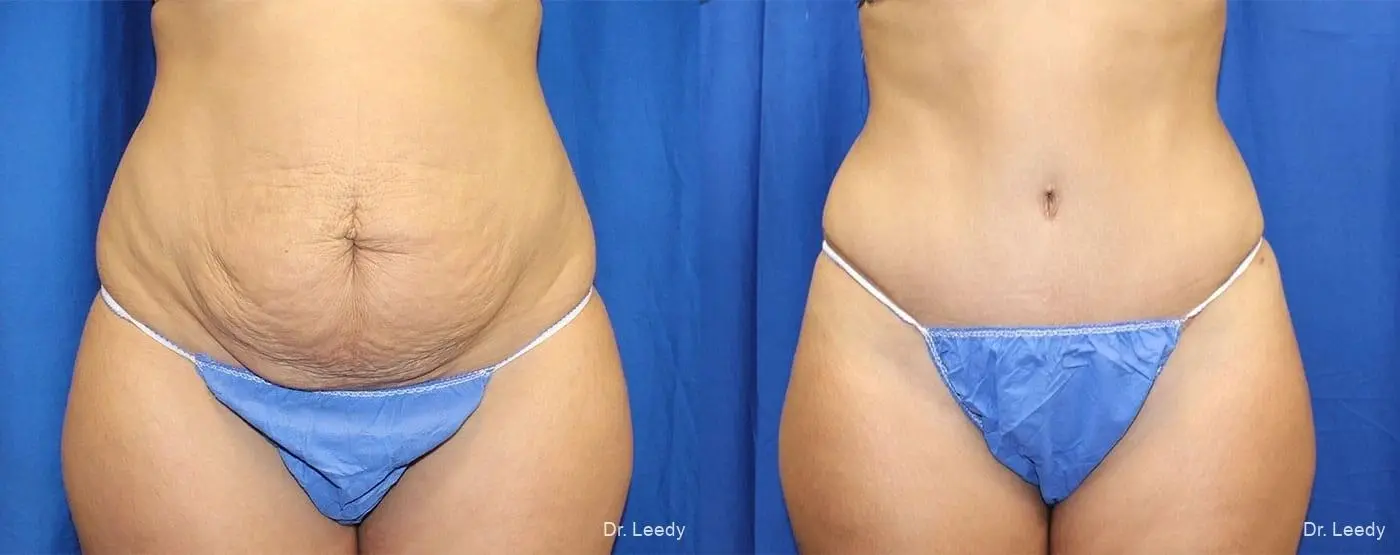 Abdominoplasty: Patient 36 - Before and After  