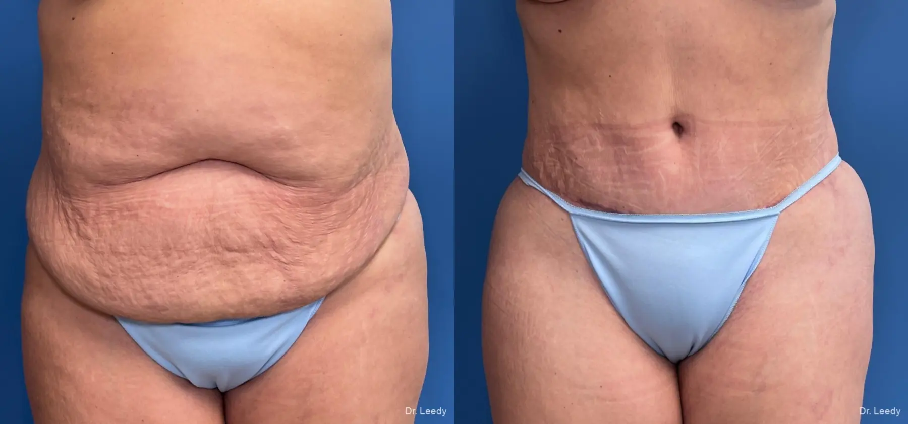 Abdominoplasty: Patient 21 - Before and After  