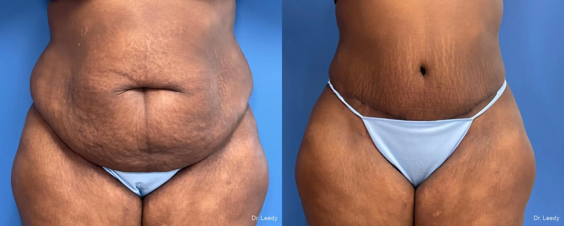 Abdominoplasty: Patient 2 - Before and After  