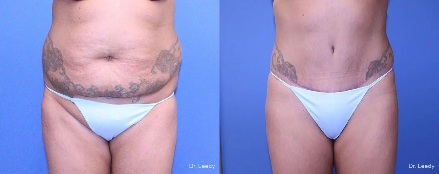 Abdominoplasty: Patient 6 - Before and After  