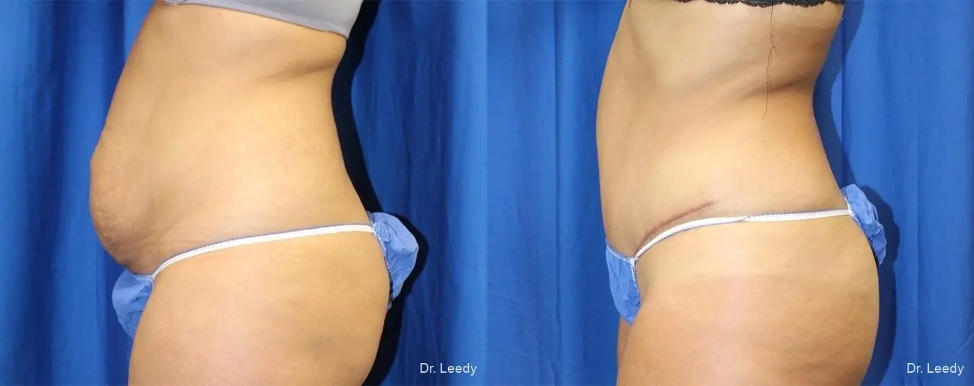 Abdominoplasty: Patient 9 - Before and After 5