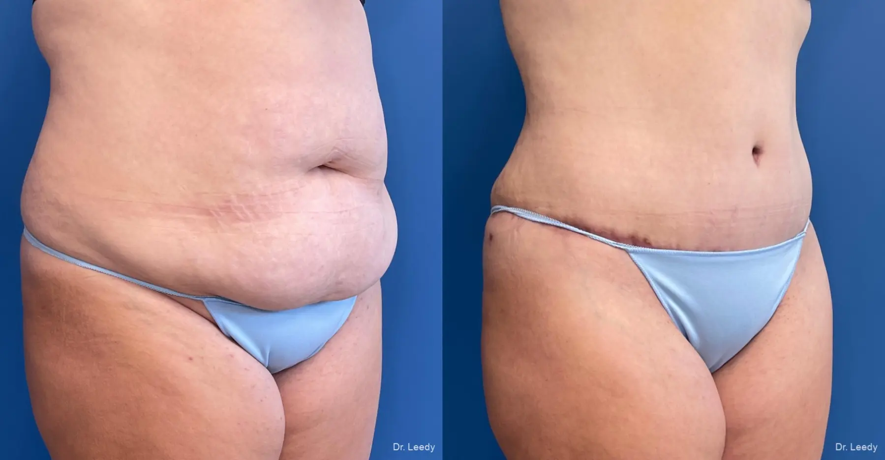 Abdominoplasty: Patient 3 - Before and After 2