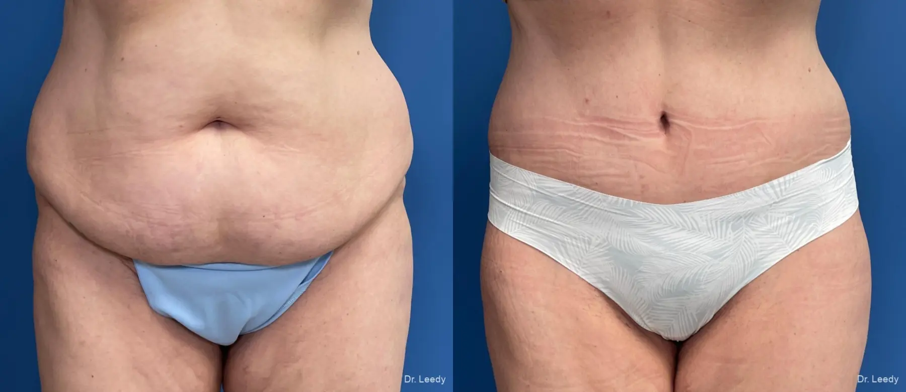 Abdominoplasty: Patient 3 - Before and After  