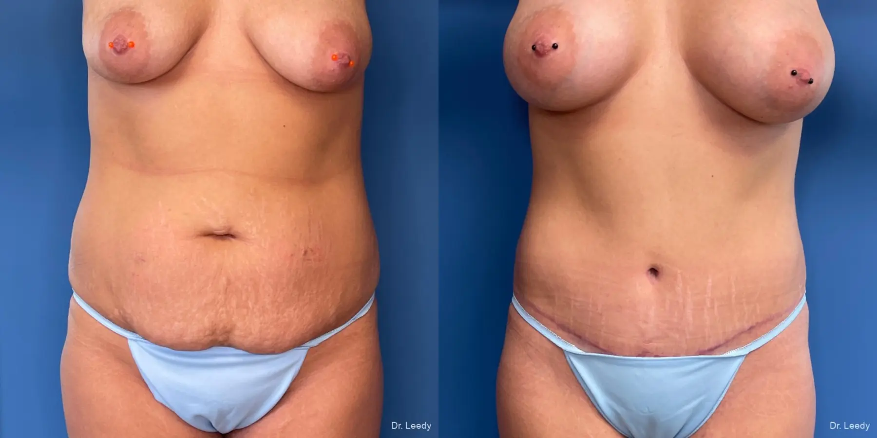 Abdominoplasty: Patient 19 - Before and After  