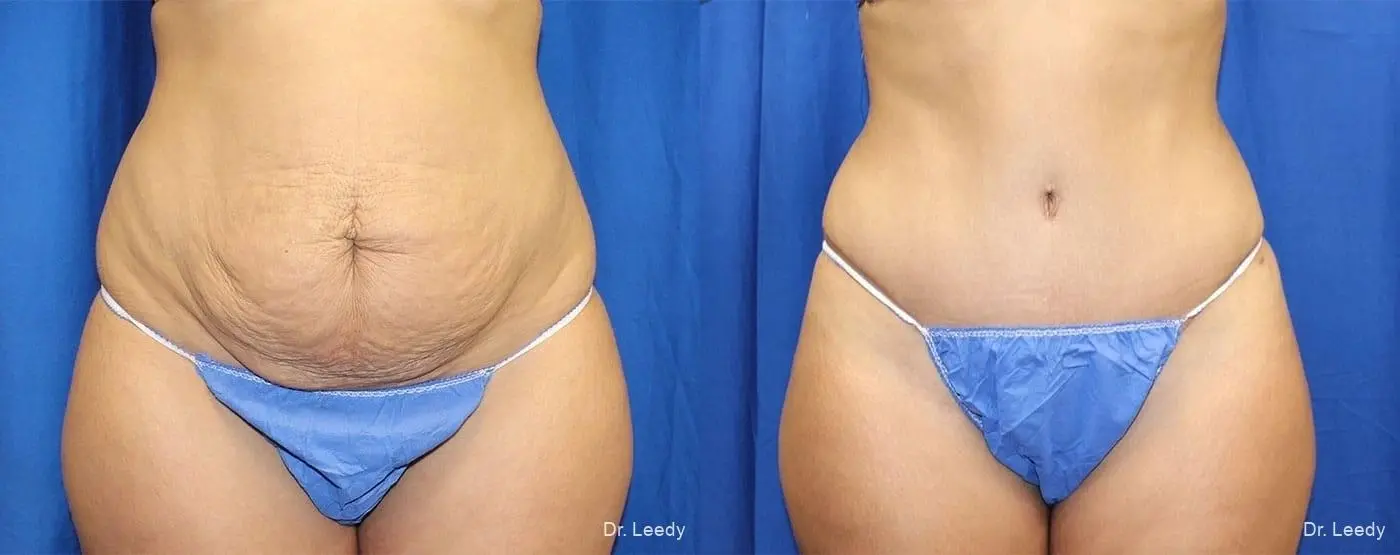 Abdominoplasty: Patient 8 - Before and After  