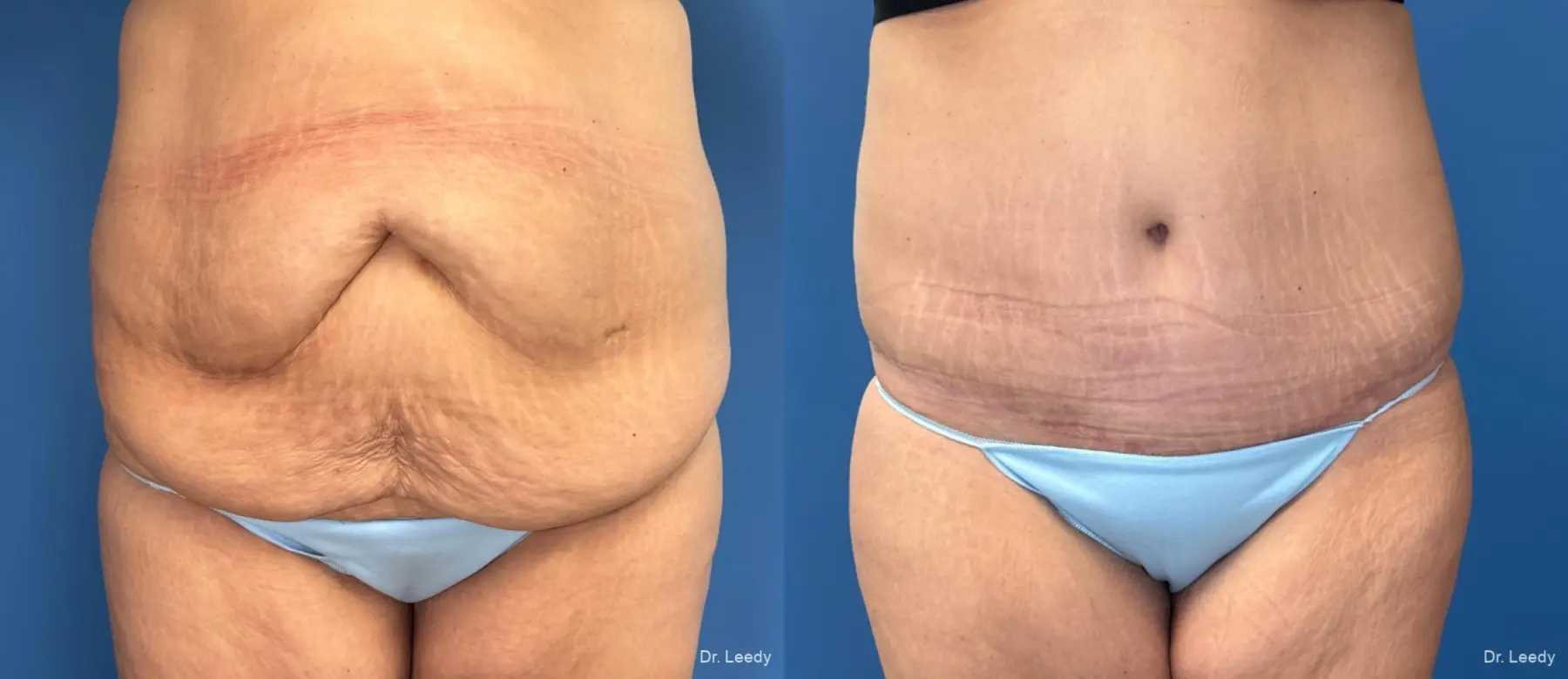 Abdominoplasty: Patient 43 - Before and After  