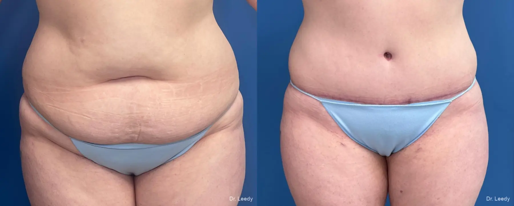 Abdominoplasty: Patient 26 - Before and After  