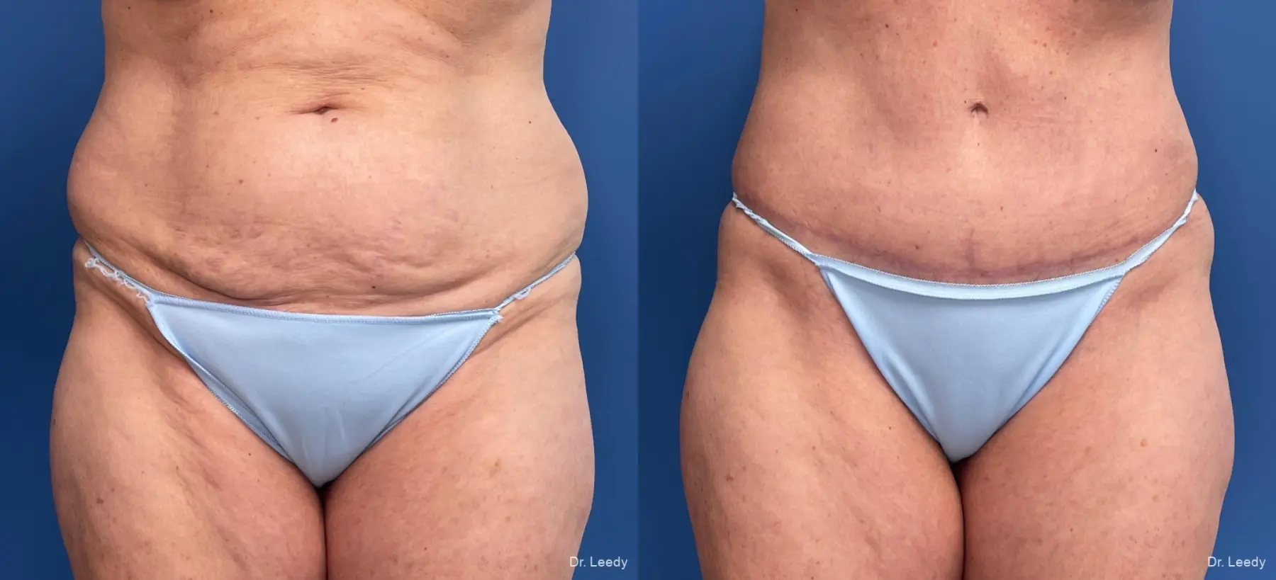 Abdominoplasty: Patient 22 - Before and After  