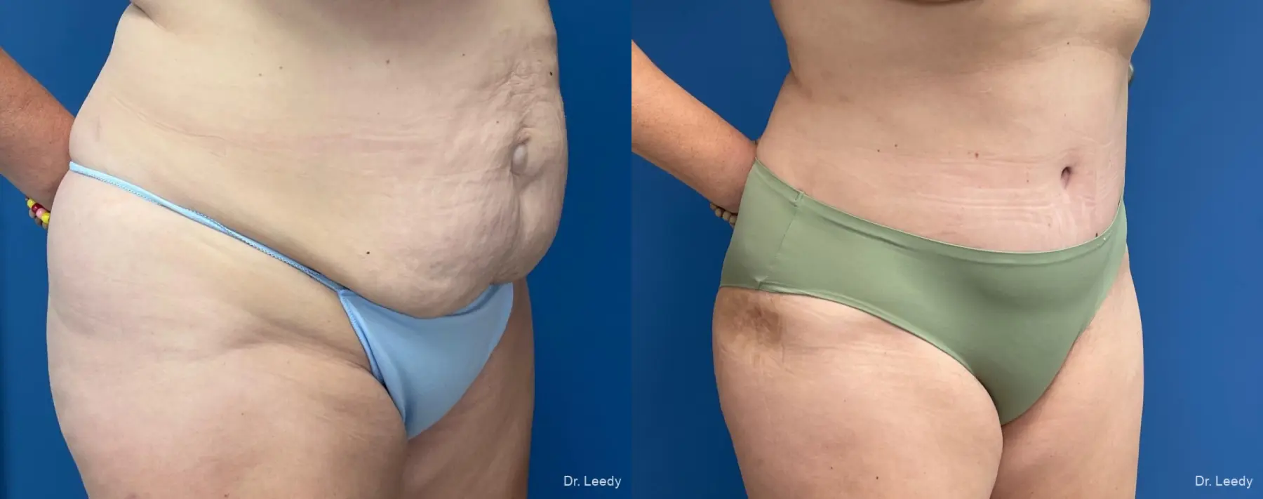 Abdominoplasty: Patient 23 - Before and After 2