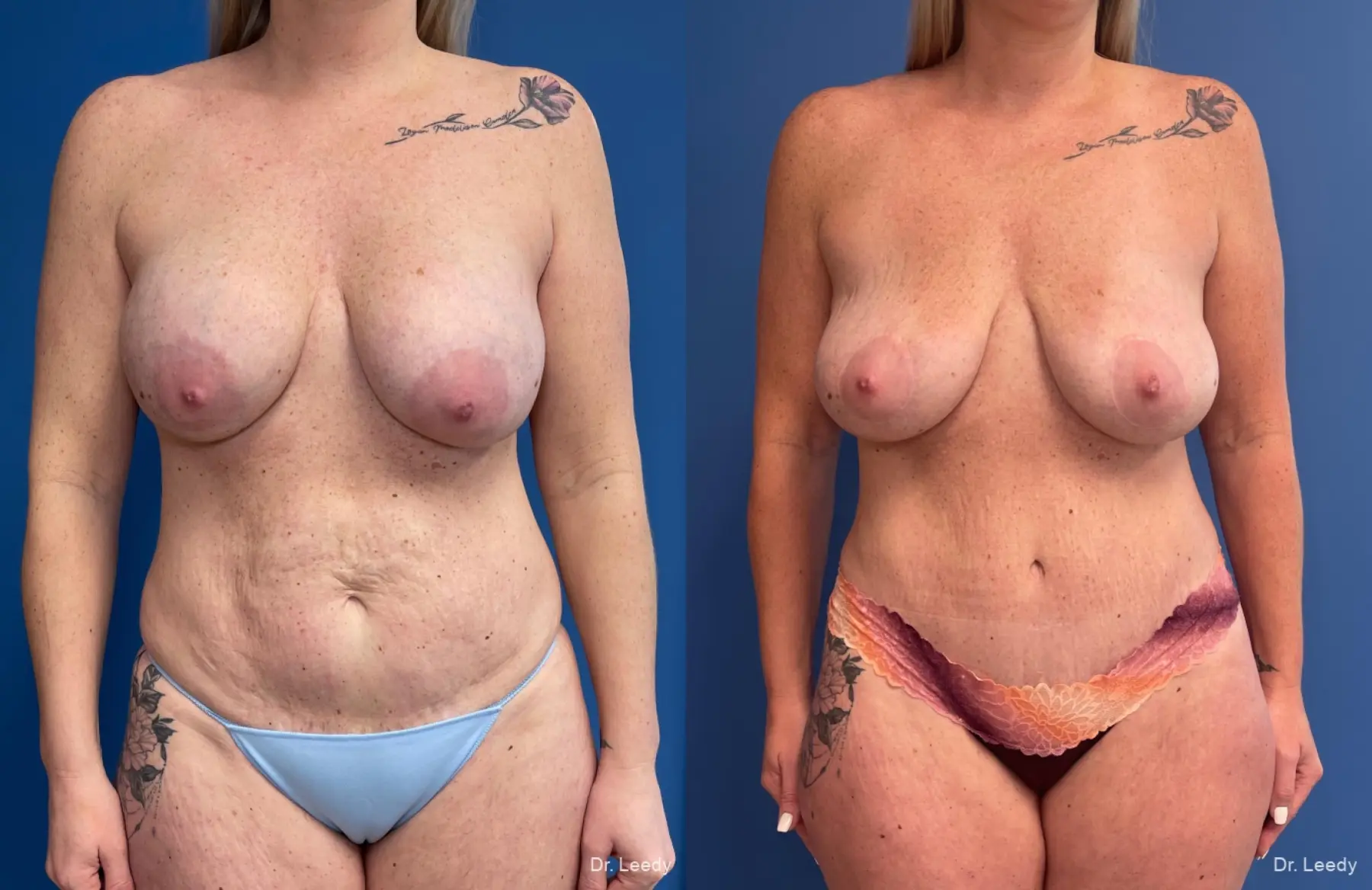 Abdominoplasty: Patient 13 - Before and After  