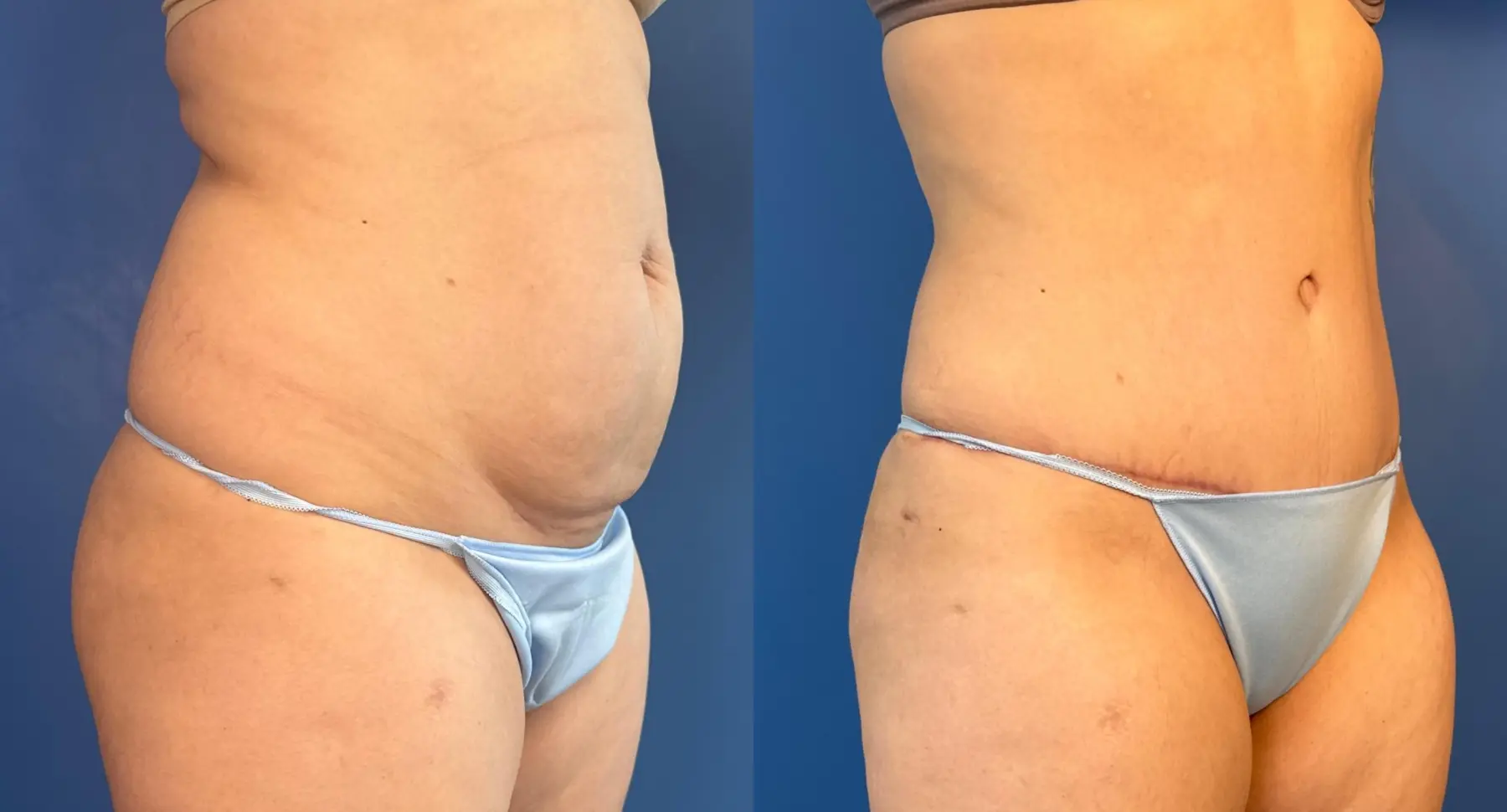 Abdominoplasty: Patient 51 - Before and After 2