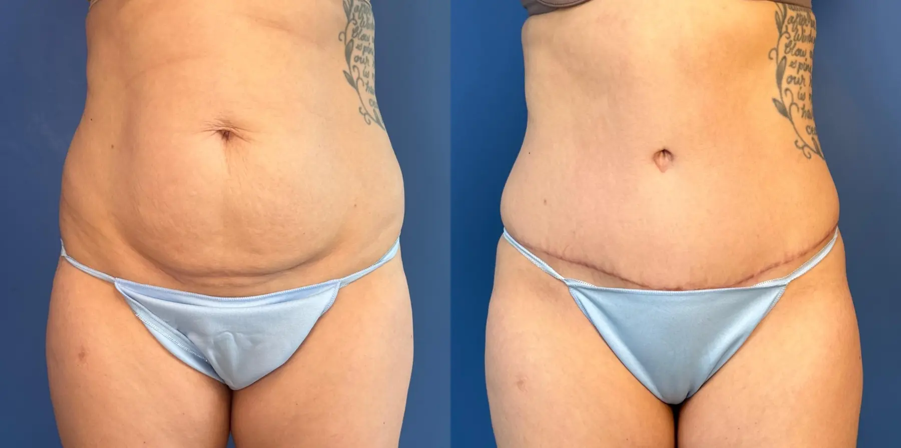 Abdominoplasty: Patient 51 - Before and After 1