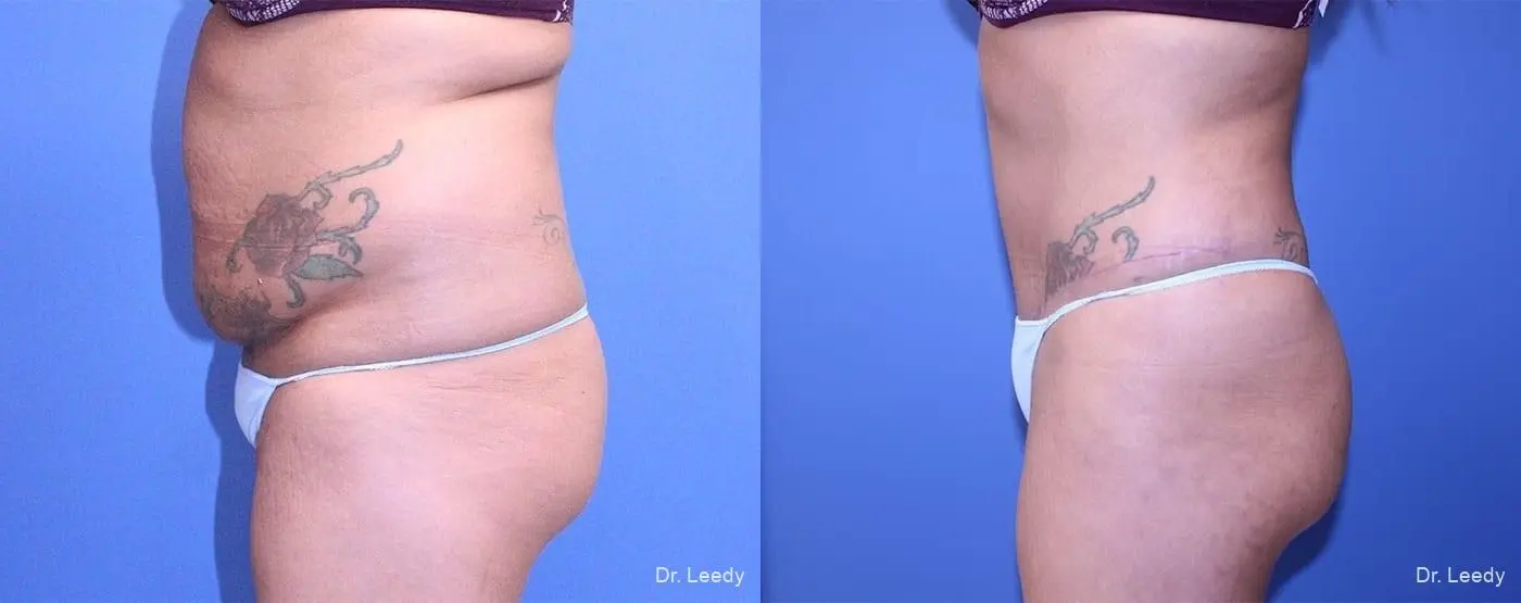 Abdominoplasty: Patient 6 - Before and After 6