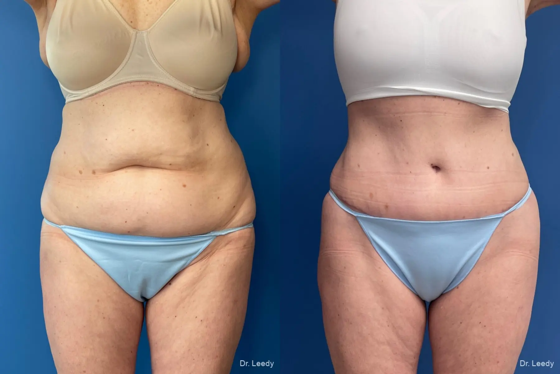 Abdominoplasty: Patient 9 - Before and After  