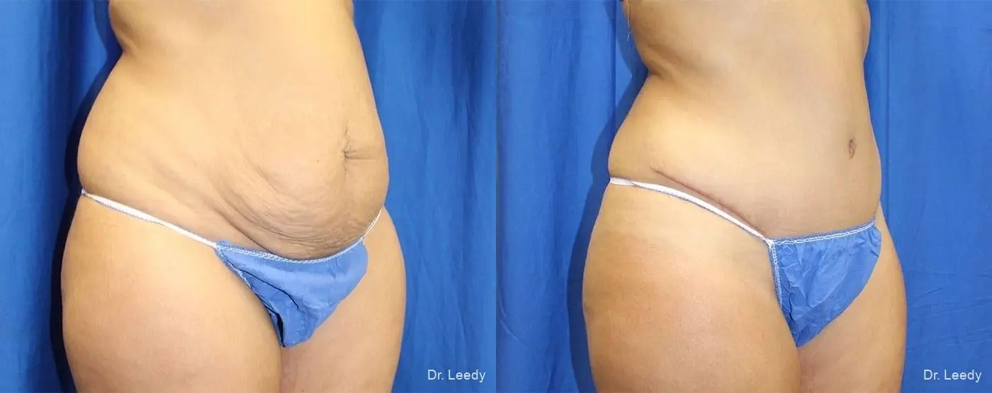 Abdominoplasty: Patient 9 - Before and After 2