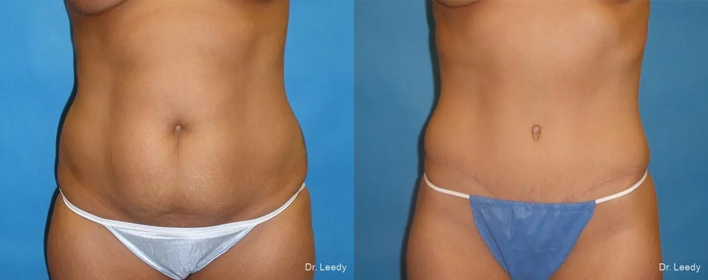 Abdominoplasty: Patient 10 - Before and After  