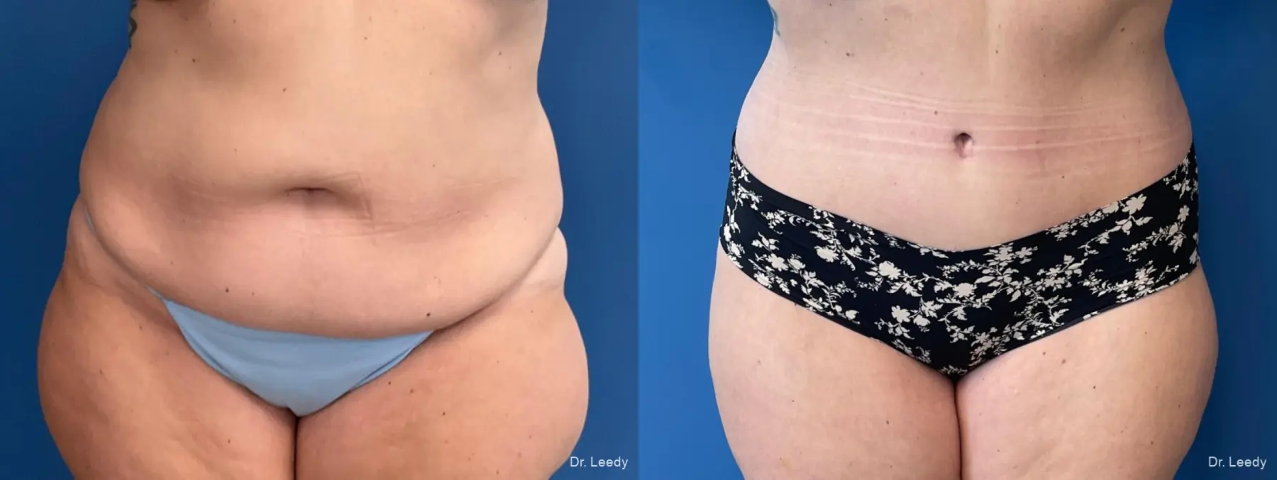 Abdominoplasty: Patient 27 - Before and After  