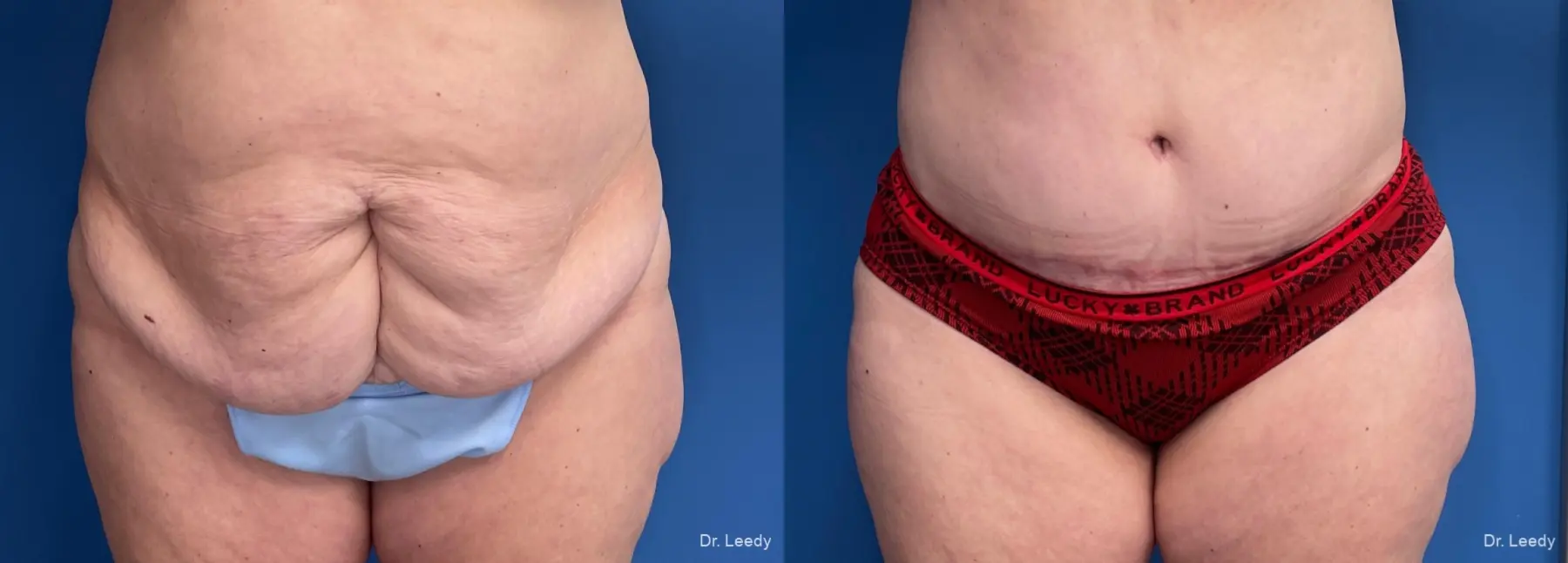 Abdominoplasty: Patient 24 - Before and After 1