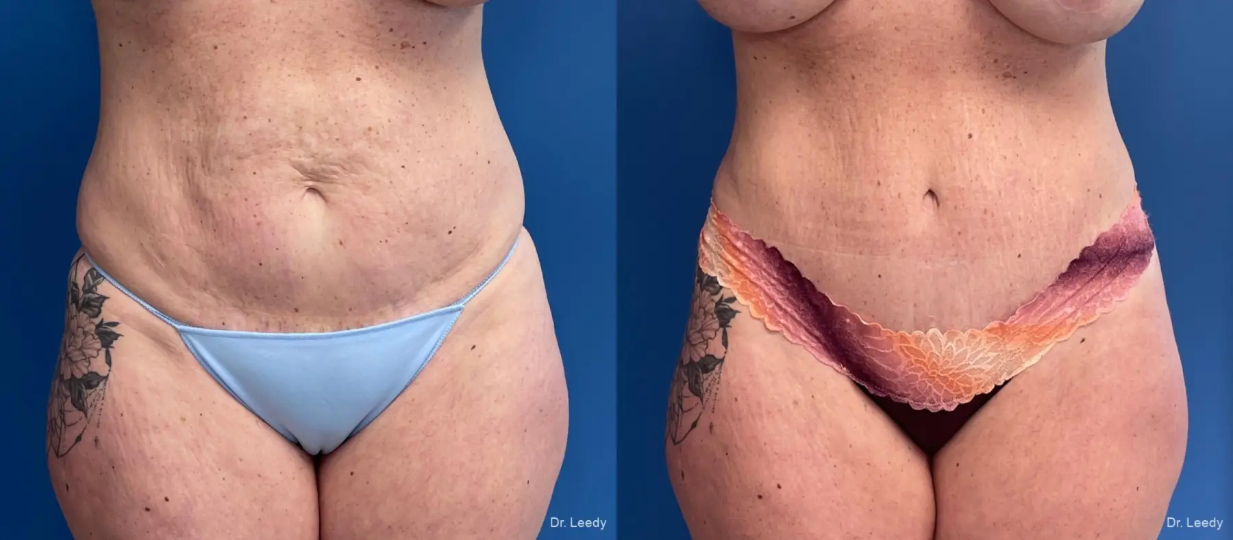 Abdominoplasty: Patient 40 - Before and After  